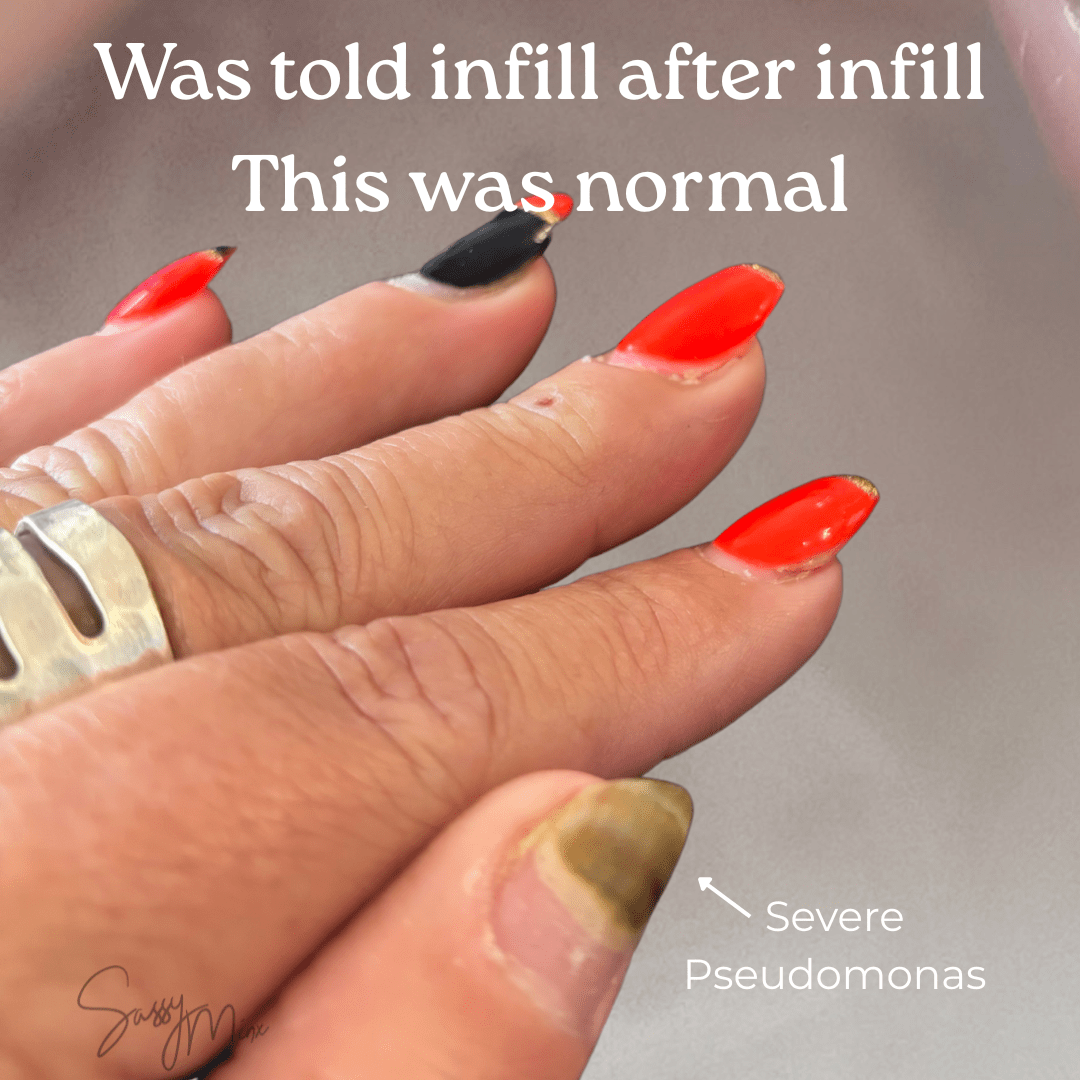 Nail showing severe lifting and area requiring removal after assessment of previous salon’s nail work