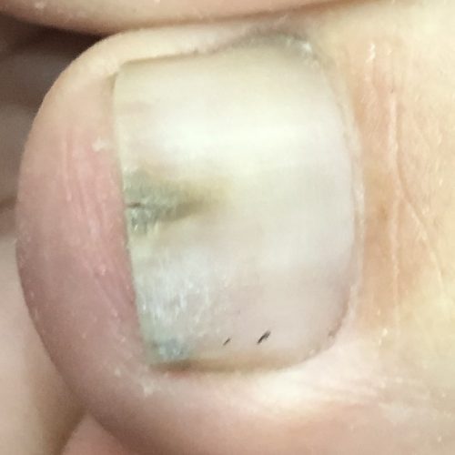 Pseudomonas-Big-Toe-min Pseudomonas-Big-Toe-min