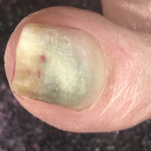 Severe-Pseudomonas-Big-Toe-min Severe-Pseudomonas-Big-Toe-min